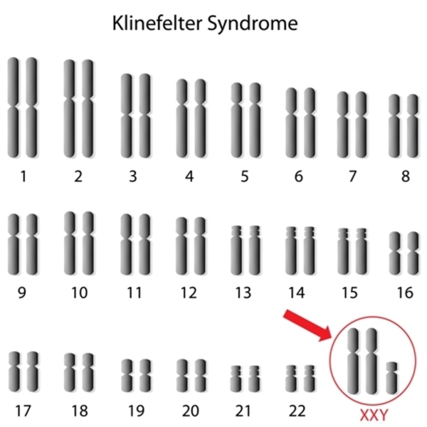 klinefelter-syndrome-karyotype.jpeg, 80kB