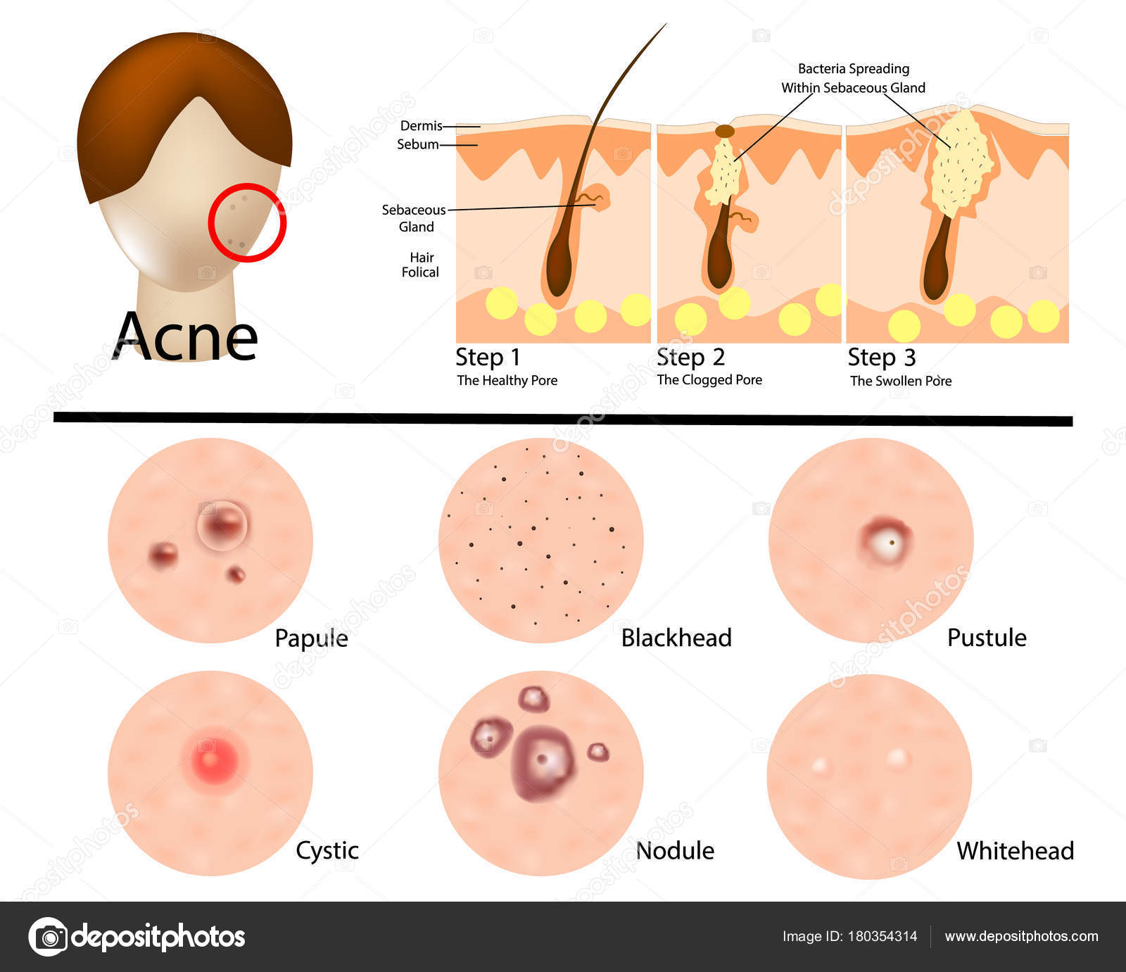 depositphotos_180354314-stock-illustration-different-types-acne-illustration-acne.jpg, 140kB